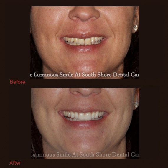 Yellow damaged teeth and flawless restoration