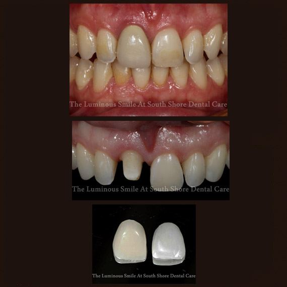 Damaged discolored teeth and dental crown and veneer restoration options