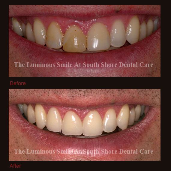 Inflamed gums and recontouring