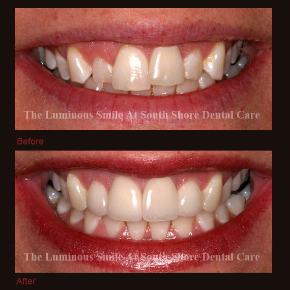 Large gums and recontouring