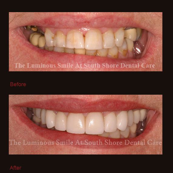 Severe tooth discoloration and damaged treated with crowns