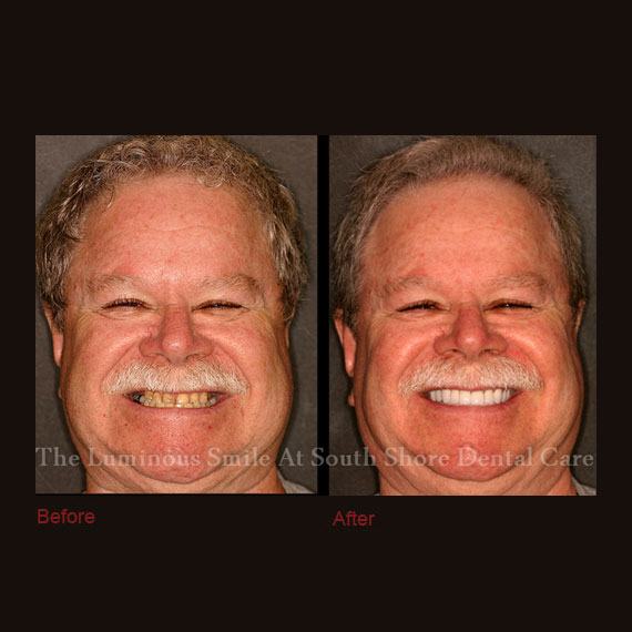Short and discolored front teeth repaired with crowns