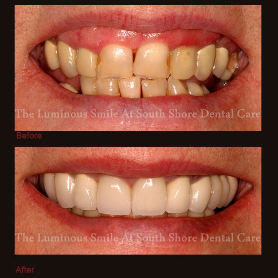 Damaged front teeth repaired with crowns