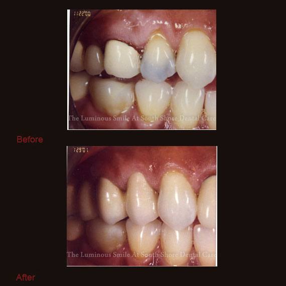 Dark colored tooth repaired with crown