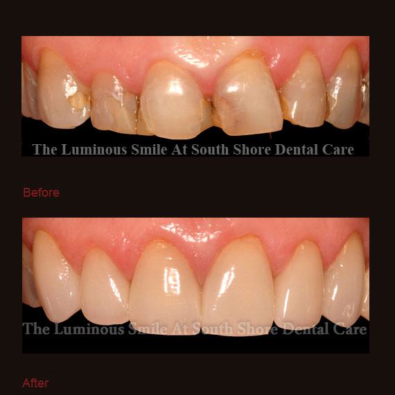 Decayed front teeth and dental crowns repair