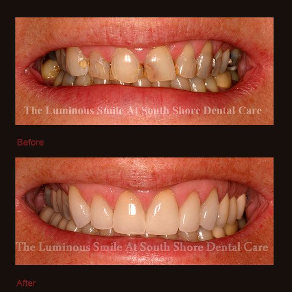Severely decayed smile repaired with crowns
