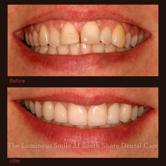 Irregularly shaped teeth and enamel shaping