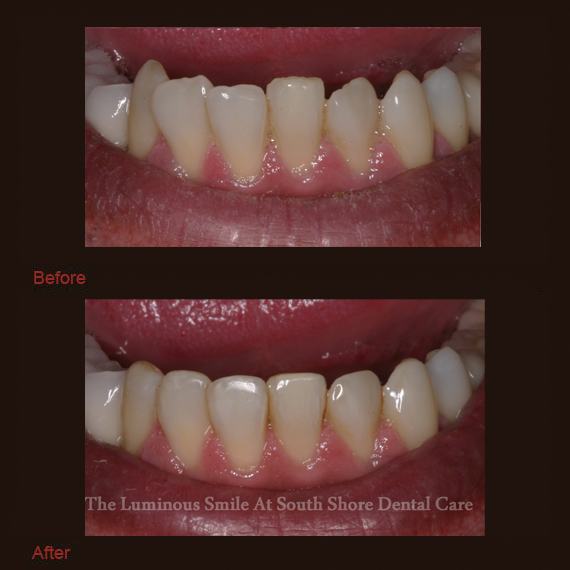 Chipped bottom teeth and enamel shaping