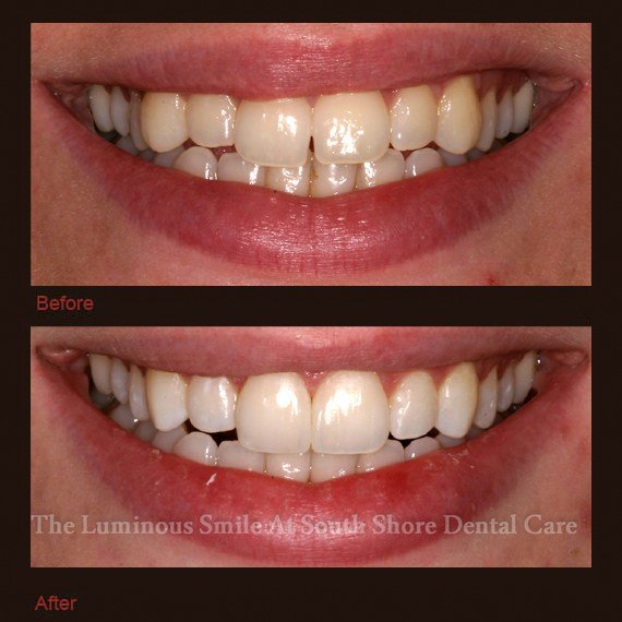 Uneven top tooth line and enamel shaping
