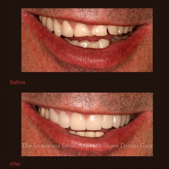 Worn teeth and enamel shaping
