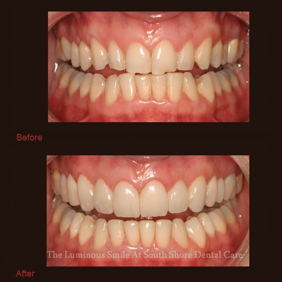 Chipped cracked teeth and enamel shaping