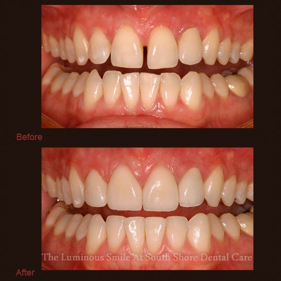 Gapped and misshapen teeth repaired with enamel shaping