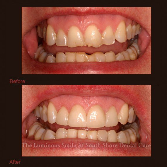 Severely chipped broken teeth repaired with enamel shaping