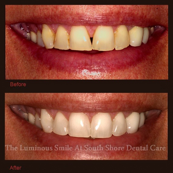 Broken damaged teeth repaired with enamel shaping