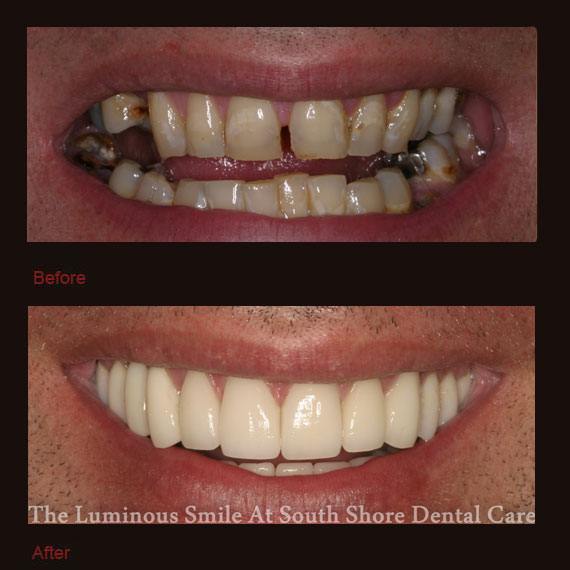 Unevenly spaced and damaged teeth and porcelain veneers