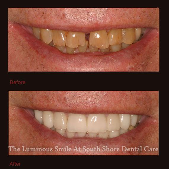 Gapped and damaged front teeth and porcelain veneers