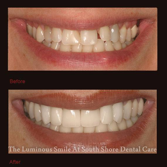 Gap between front tooth and side tooth and porcelain veneers