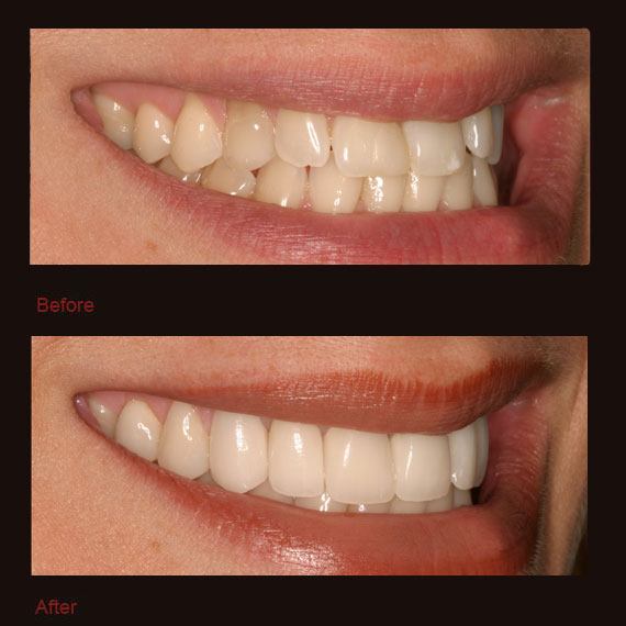 Overlapping front teeth and porcelain veneers