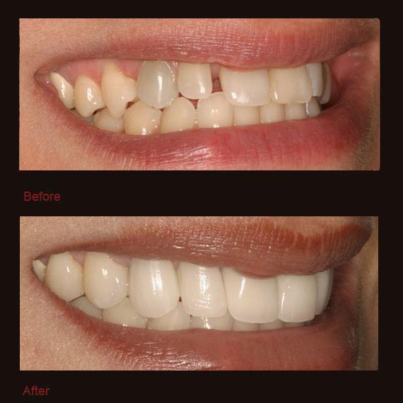 Gap between teeth to the side and porcelain veneers