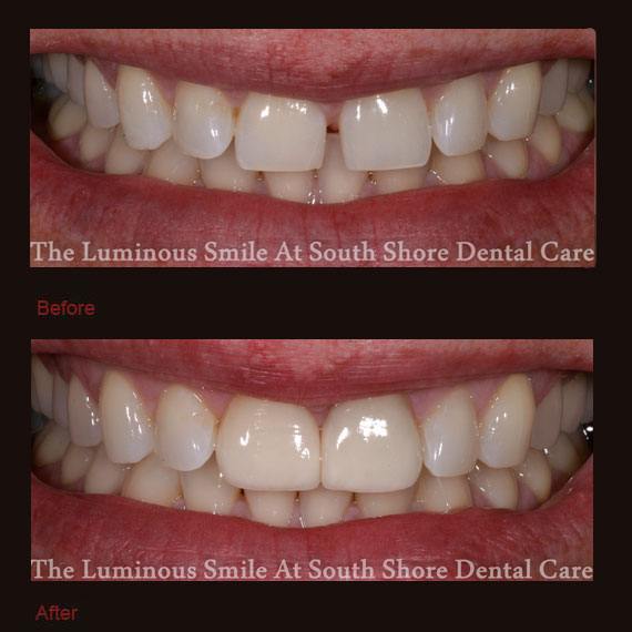 Gapped front teeth flared outward and porcelain veneers