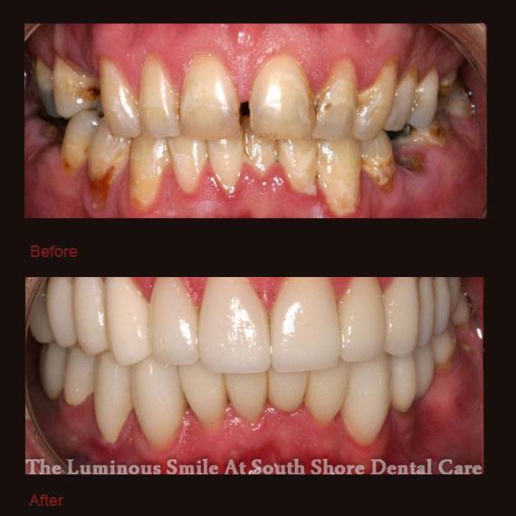 Numerous dental gaps and flaws and porcelain veneers