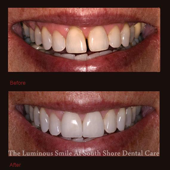 Yellow and gapped front teeth and porcelain veneers
