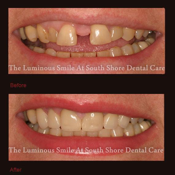 Extreme front tooth gap and porcelain veneers