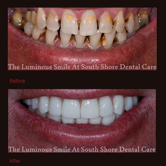 Yellow and uneven teeth and porcelain veneers