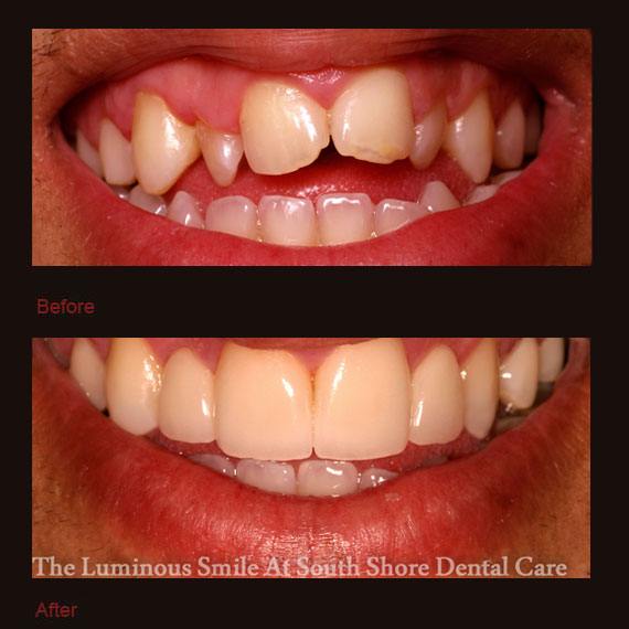 Crooked and damaged teeth and porcelain veneers repaired