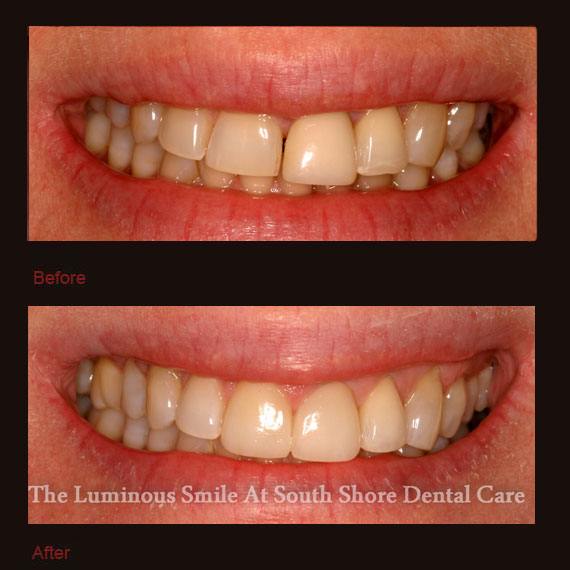 Gapped and damaged teeth and porcelain veneers repaired