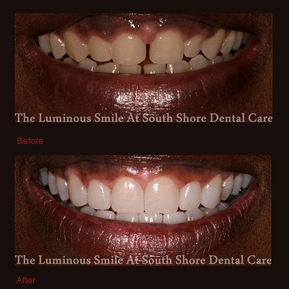 Top and bottom tooth gaps and porcelain veneers