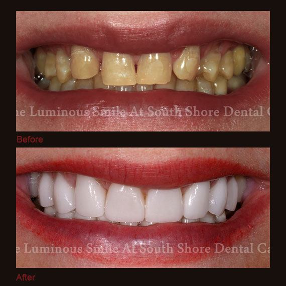 Before and after images severe damage and discoloration and full veneer