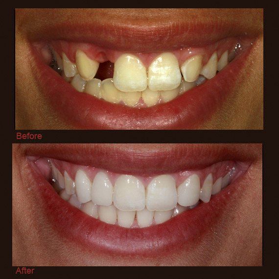 Before and after images missing tooth yellowed smile and full veneer