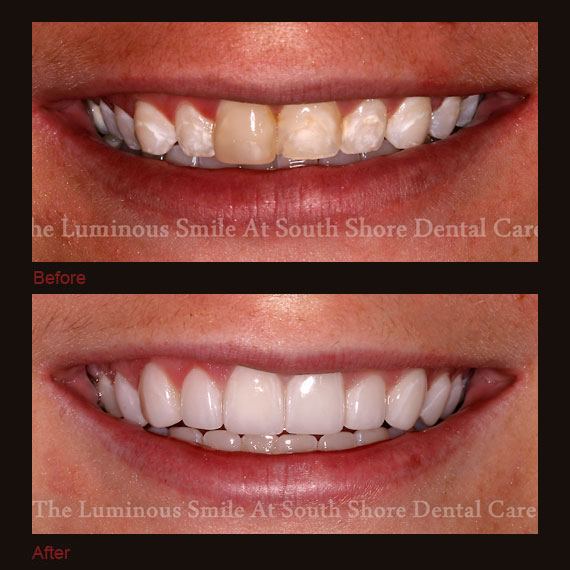Before and after images yellowed teeth and full veneers
