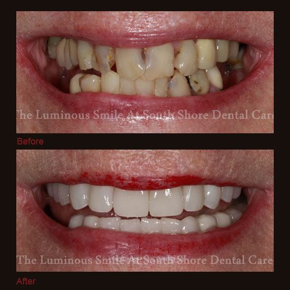 Before and after images severe decay and full veneers