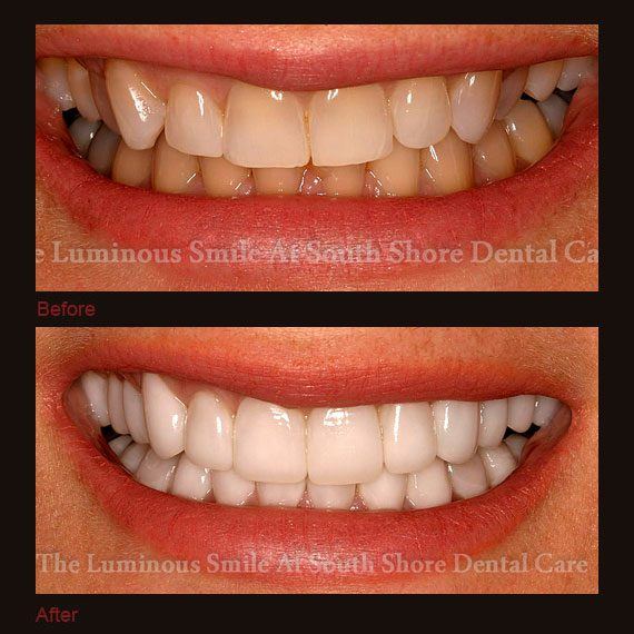 Before and after images yellow teeth and full veneers