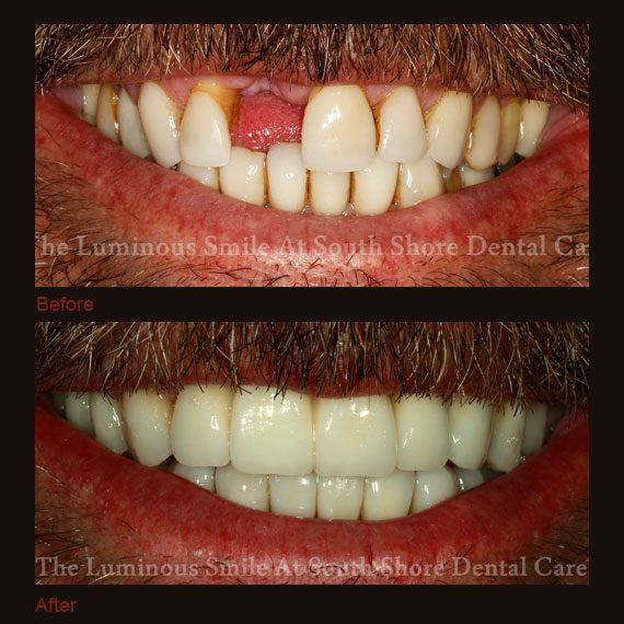 Before and after images missing damaged teeth and full veneers