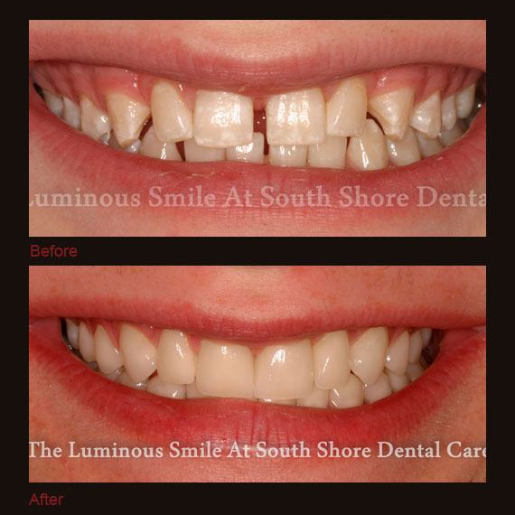 Before and after images unevenly spaced teeth and full veneers