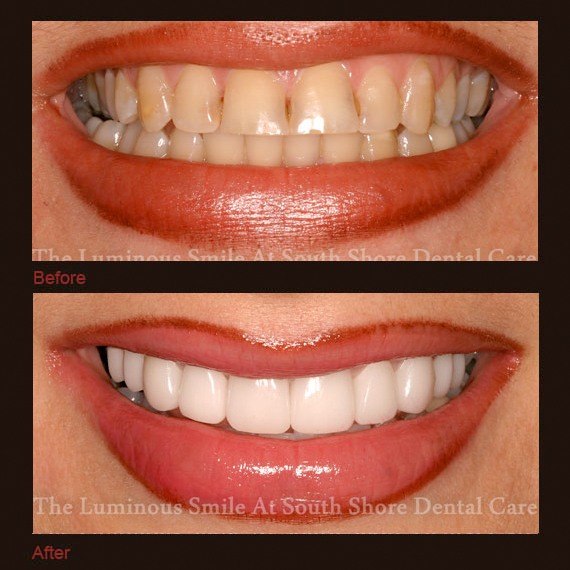 Before and after images yellow stubby teeth and full veneers