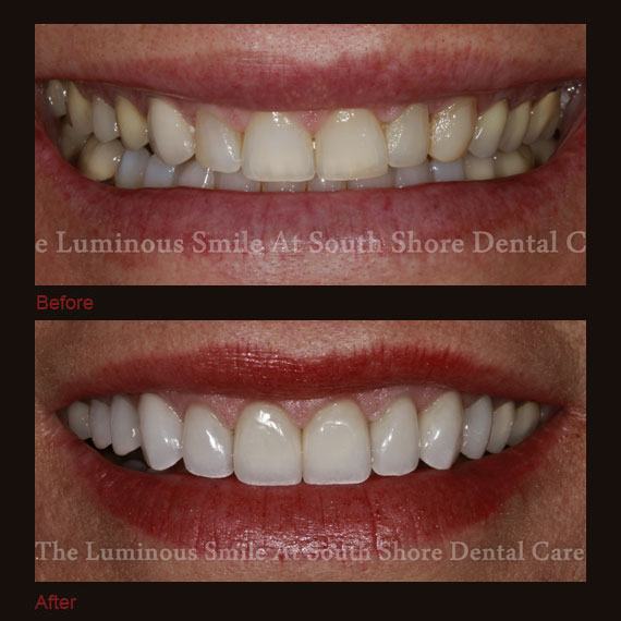 Before and after images yellowed teeth and flawless full veneer
