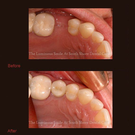 Missing bottom tooth and implant supported dental crown