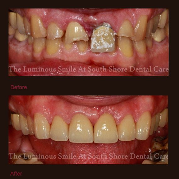 Severely damaged teeth and implant restorations