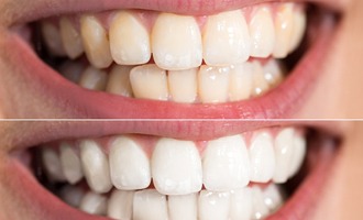 A before and after photo of teeth that have been whitened