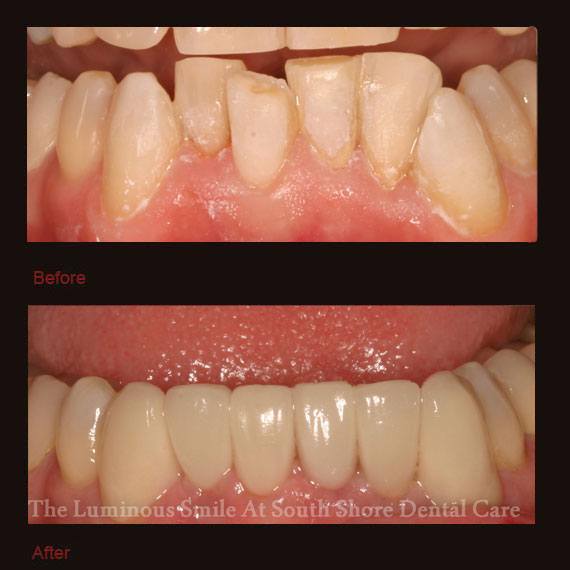 Decayed and discolored bottom teeth and veneers