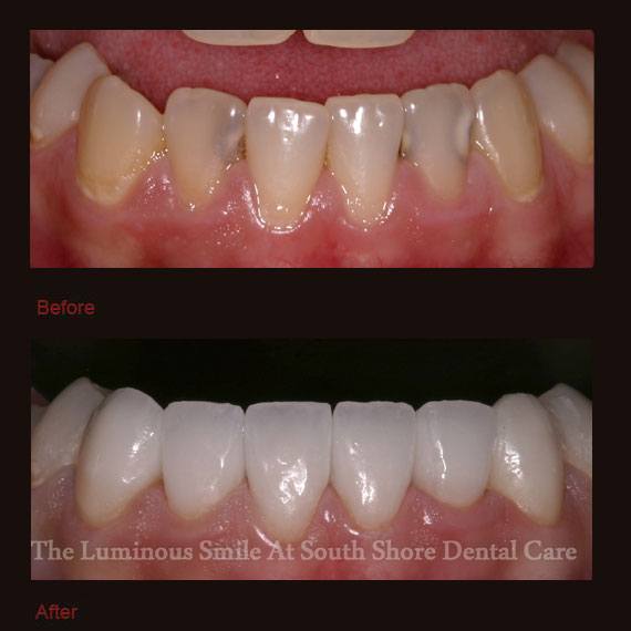 Cavities and discoloration on bottom teeth and veneers