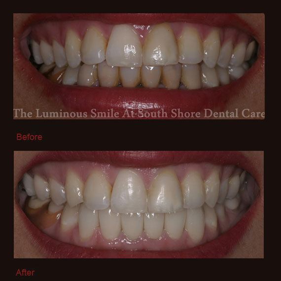 Black and dark discoloration on bottom teeth and veneeers