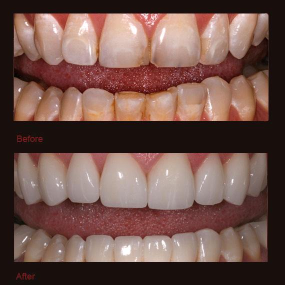 Decay and damage on bottom teeth and veneers
