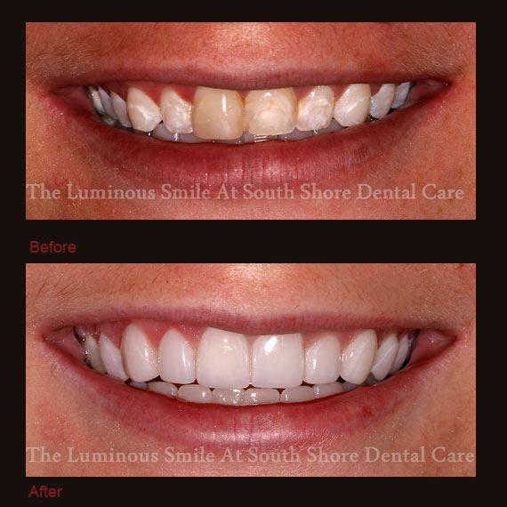 Before and after damaged teeth and flawless lumineers