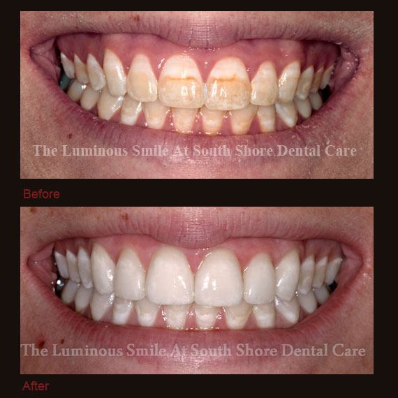 Before and after dark colored teeth and flawless lumineers