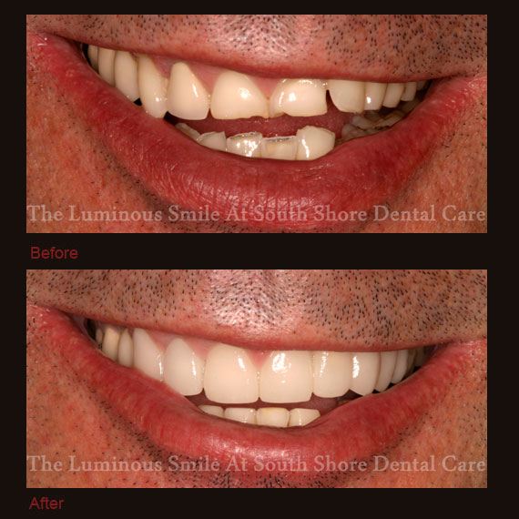 Before and after worn teeth and flawless lumineers